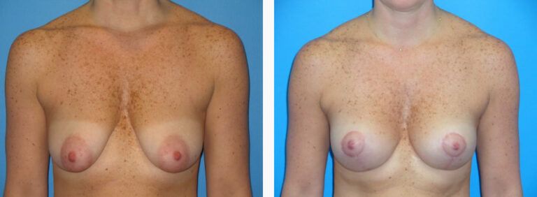Breast Lift before and after treatment