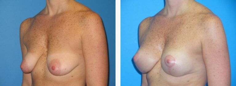 Breast Lift before and after treatment