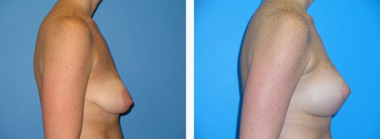 Breast Lift before and after treatment