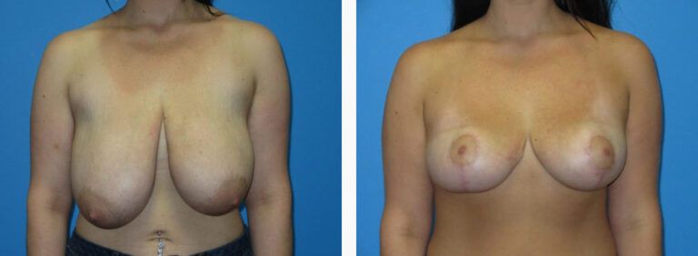 Breast Reduction before and after treatment