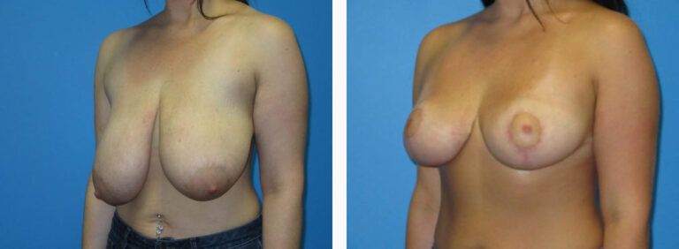 Breast Reduction before and after treatment