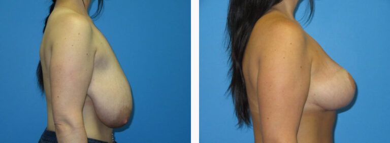 Breast Reduction before and after treatment