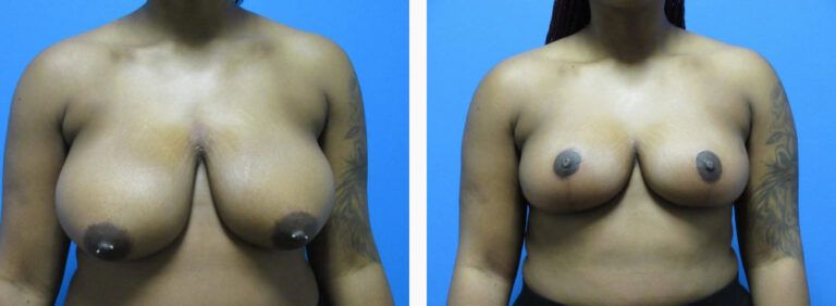 Breast Reduction before and after treatment