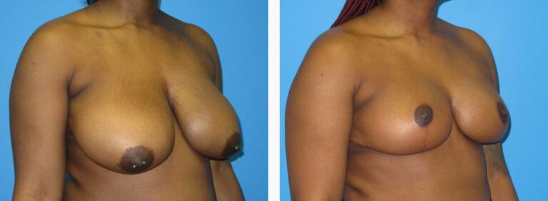 Breast Reduction before and after treatment