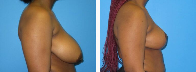 Breast Reduction before and after treatment