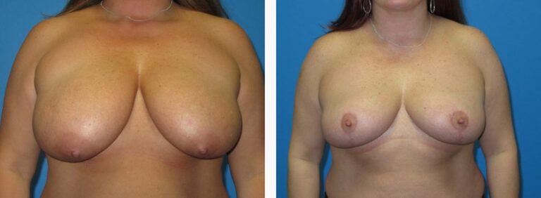 Breast Reduction before and after treatment