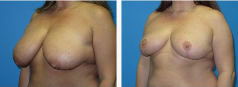 Breast Reduction before and after treatment