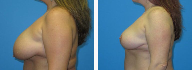 Breast Reduction before and after treatment