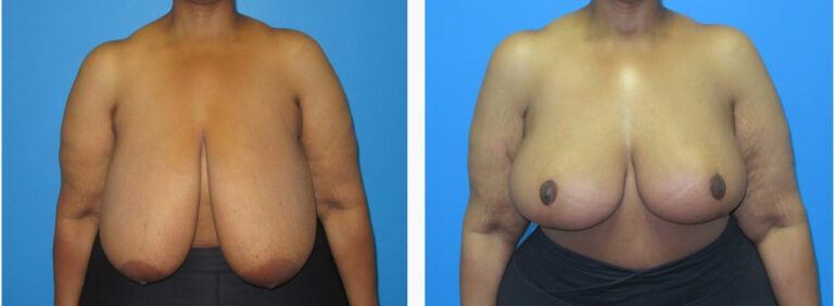 Breast Reduction before and after treatment