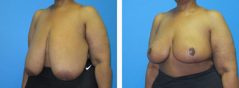 Breast Reduction before and after treatment