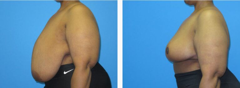 Breast Reduction before and after treatment
