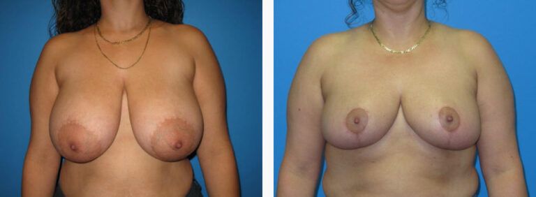 Breast Reduction before and after treatment