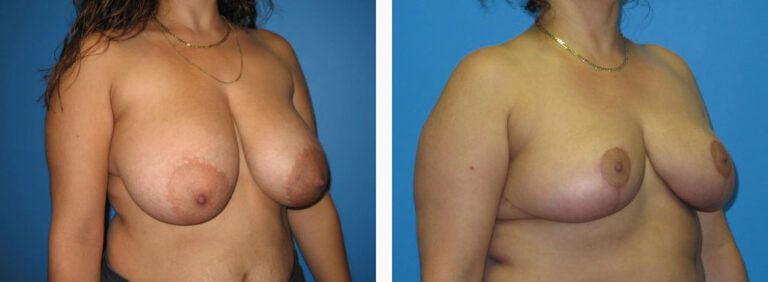 Breast Reduction before and after treatment