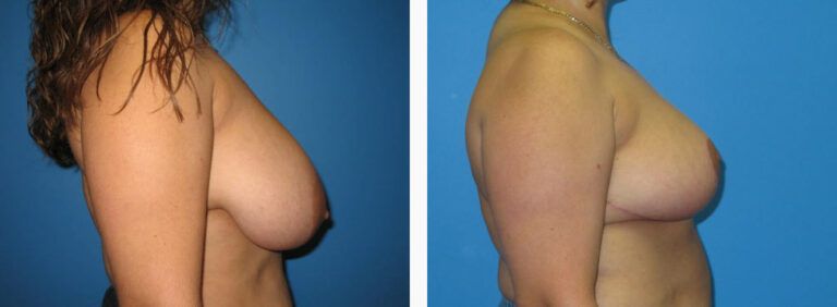 Breast Reduction before and after treatment