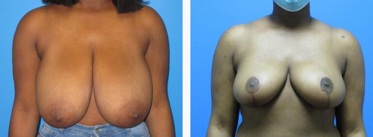 Breast Reduction before and after treatment