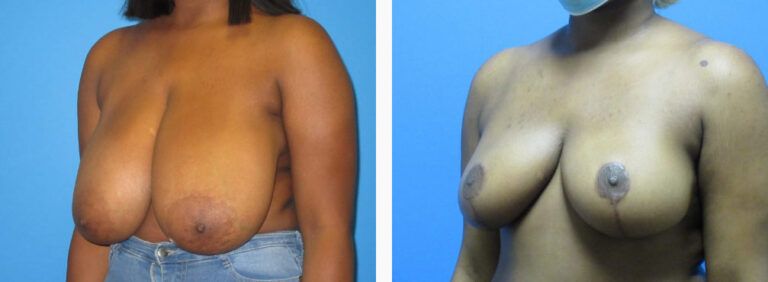 Breast Reduction before and after treatment