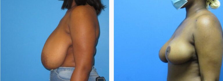 Breast Reduction before and after treatment