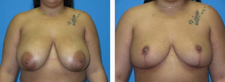 Breast Reduction before and after treatment