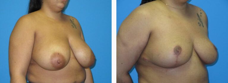 Breast Reduction before and after treatment