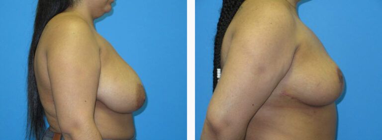 Breast Reduction before and after treatment