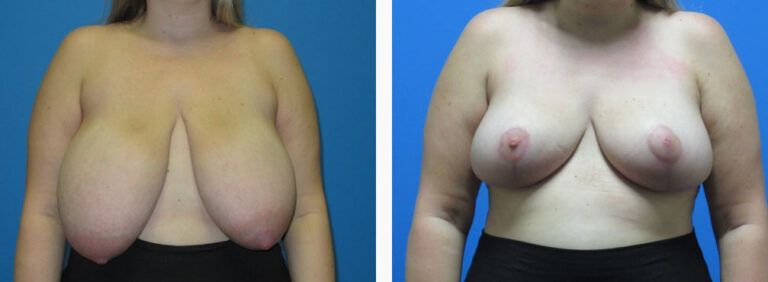 Breast Reduction before and after treatment