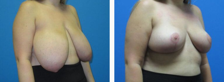 Breast Reduction before and after treatment