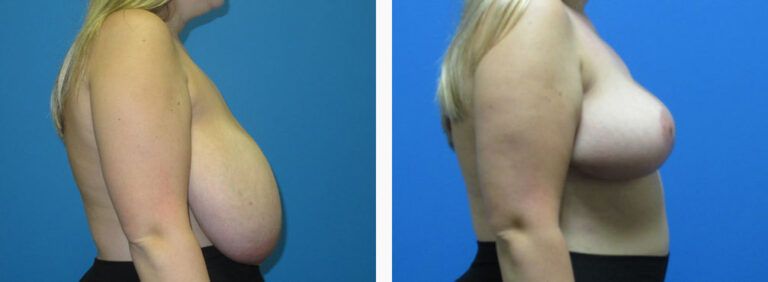Breast Reduction before and after treatment