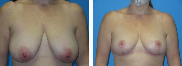 Breast Reduction before and after treatment