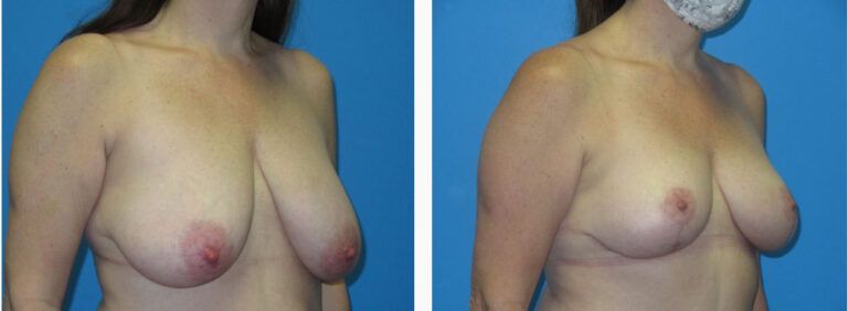 Breast Reduction before and after treatment