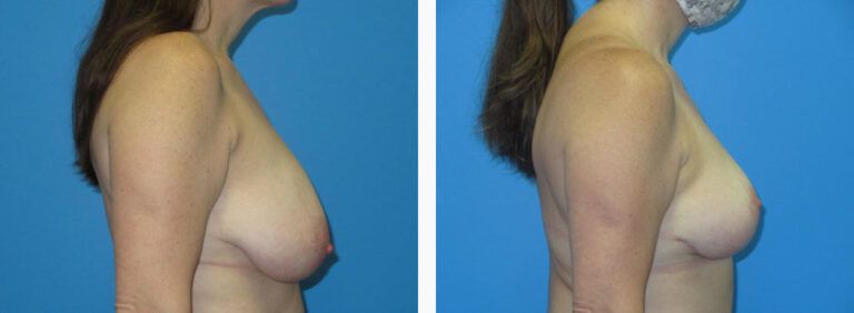 Breast Reduction before and after treatment