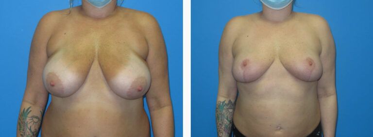 Breast Reduction before and after treatment