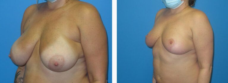 Breast Reduction before and after treatment