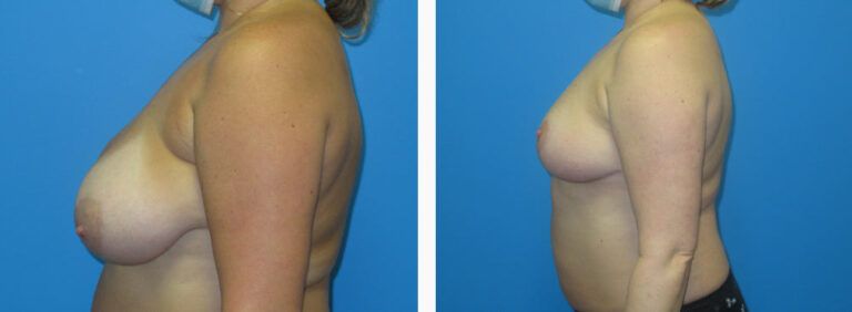 Breast Reduction before and after treatment