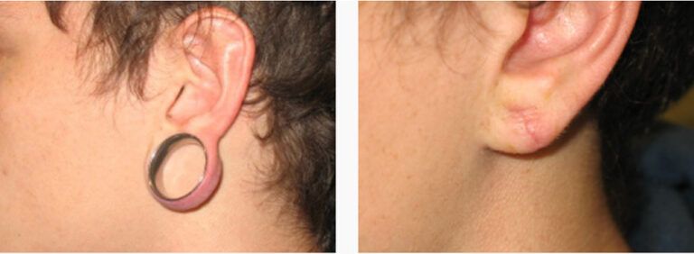 Earlobe Repair before and after treatment