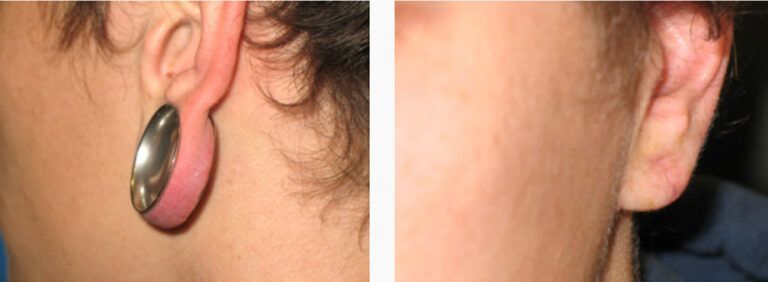 Earlobe Repair before and after treatment