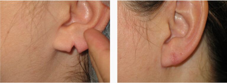 Earlobe Repair before and after treatment