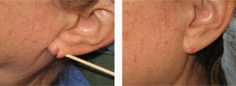 Earlobe Repair before and after treatment