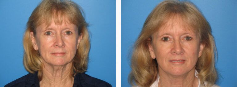Facelift before and after treatment