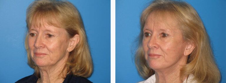 Facelift before and after treatment