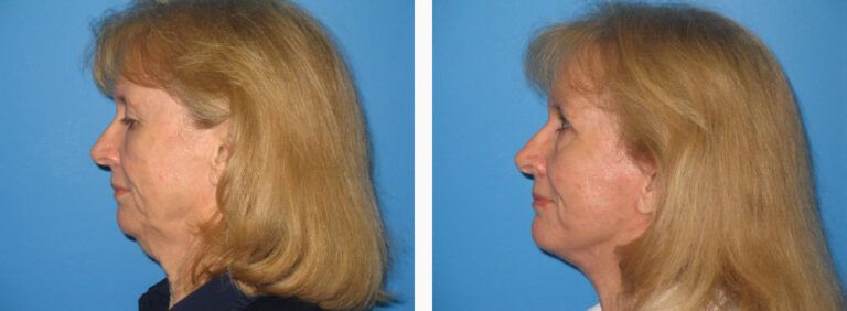 Facelift before and after treatment