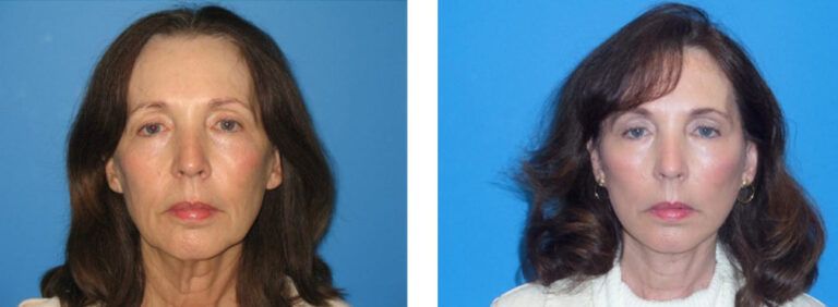 Facelift before and after treatment