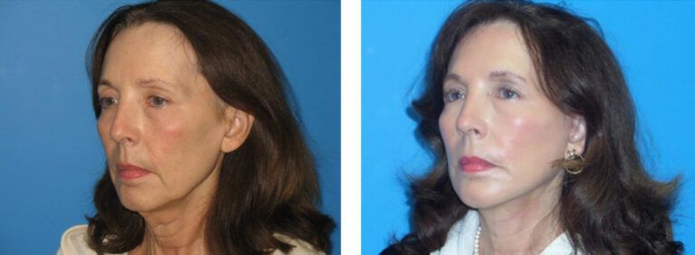 Facelift before and after treatment
