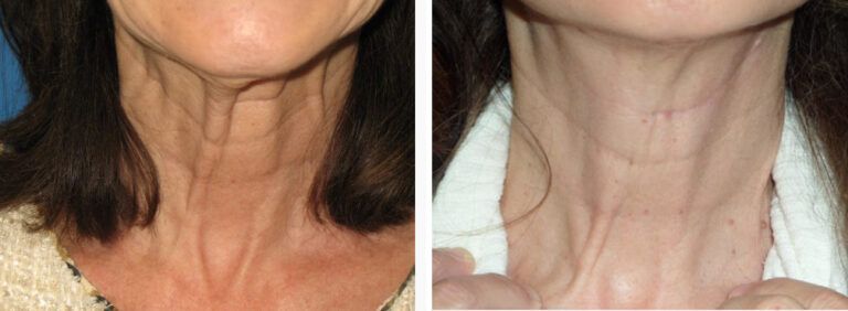 Facelift before and after treatment