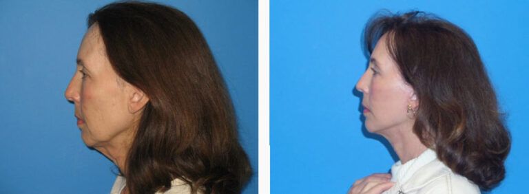 Facelift before and after treatment