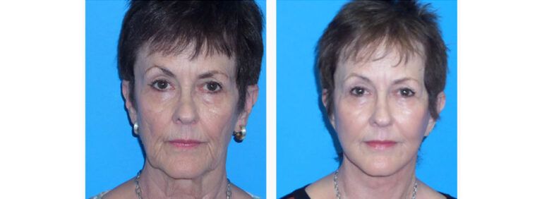 Facelift before and after treatment