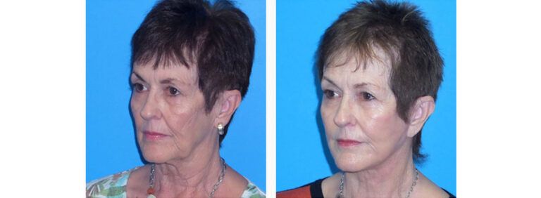 Facelift before and after treatment