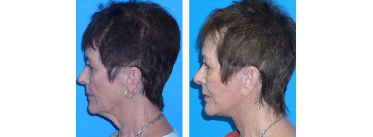 Facelift before and after treatment