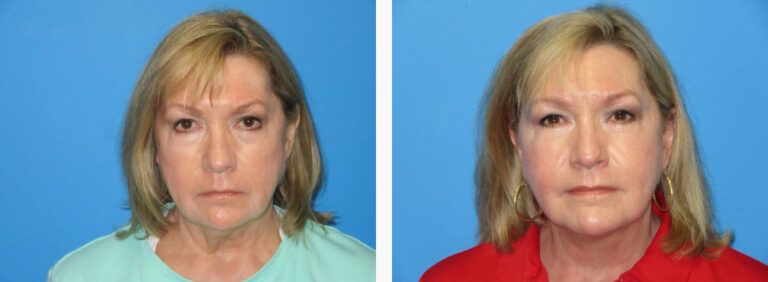 Facelift before and after treatment