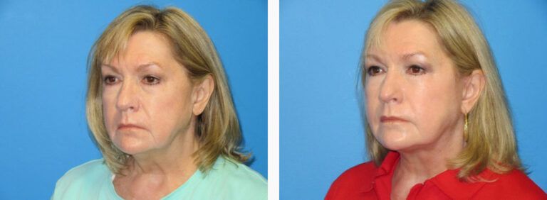 Facelift before and after treatment