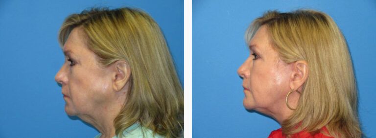 Facelift before and after treatment